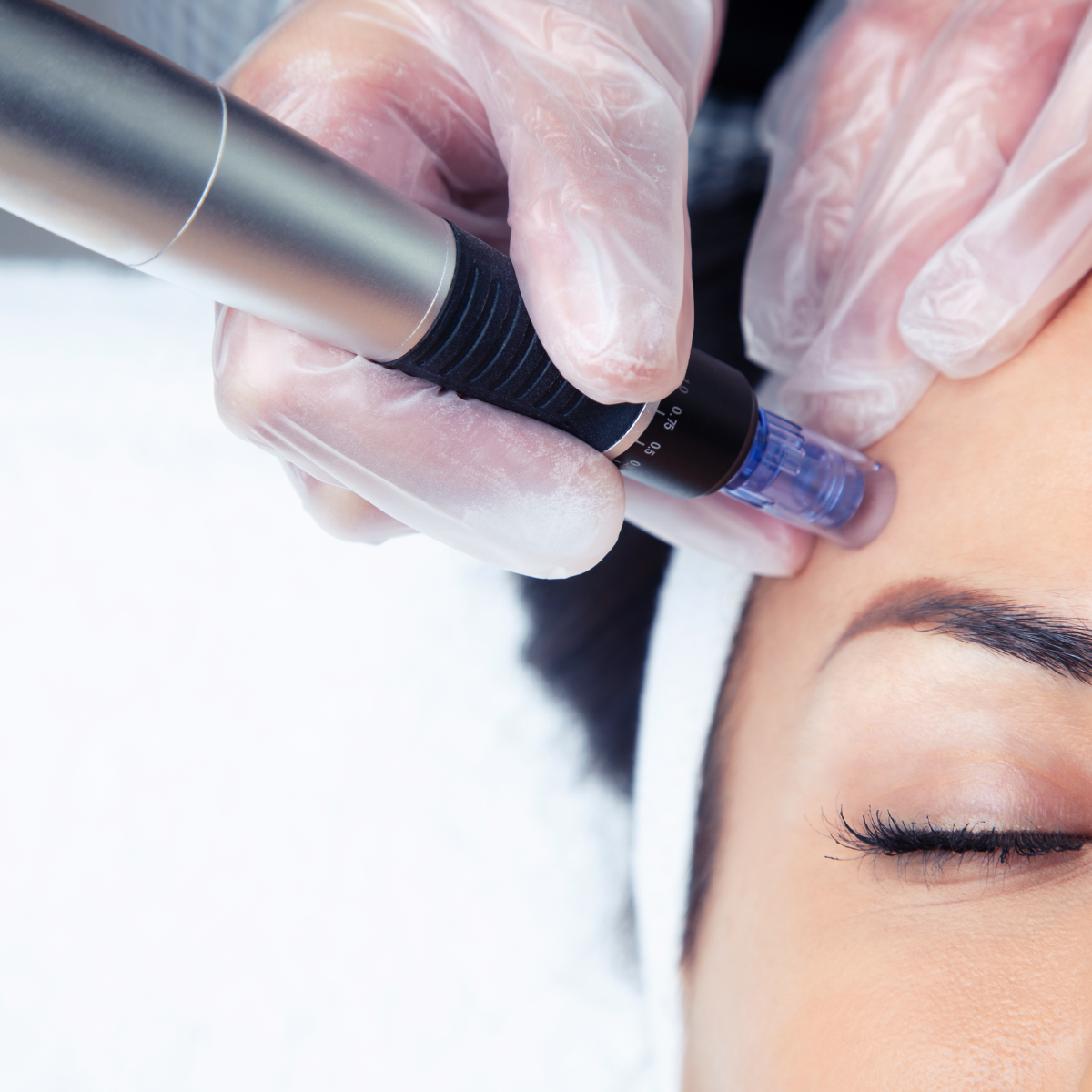 Microneedling Ausbildung